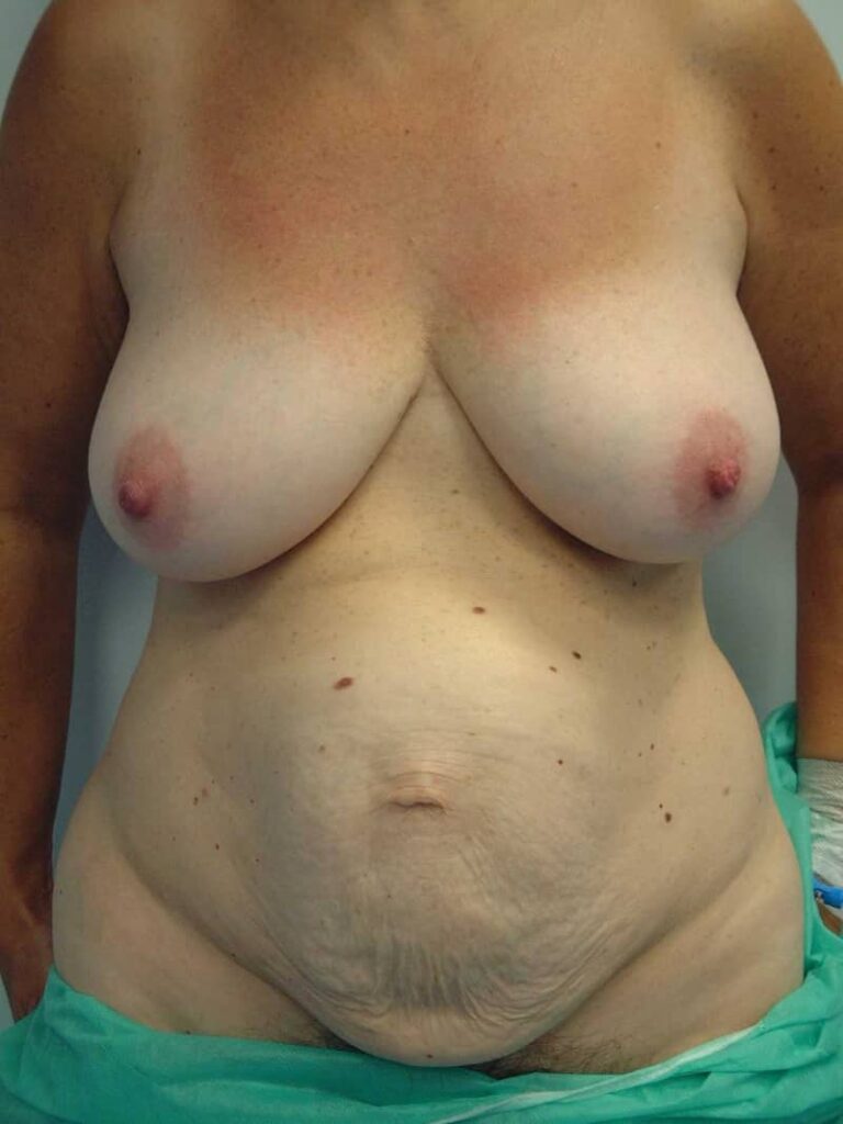 Tummy tuck before