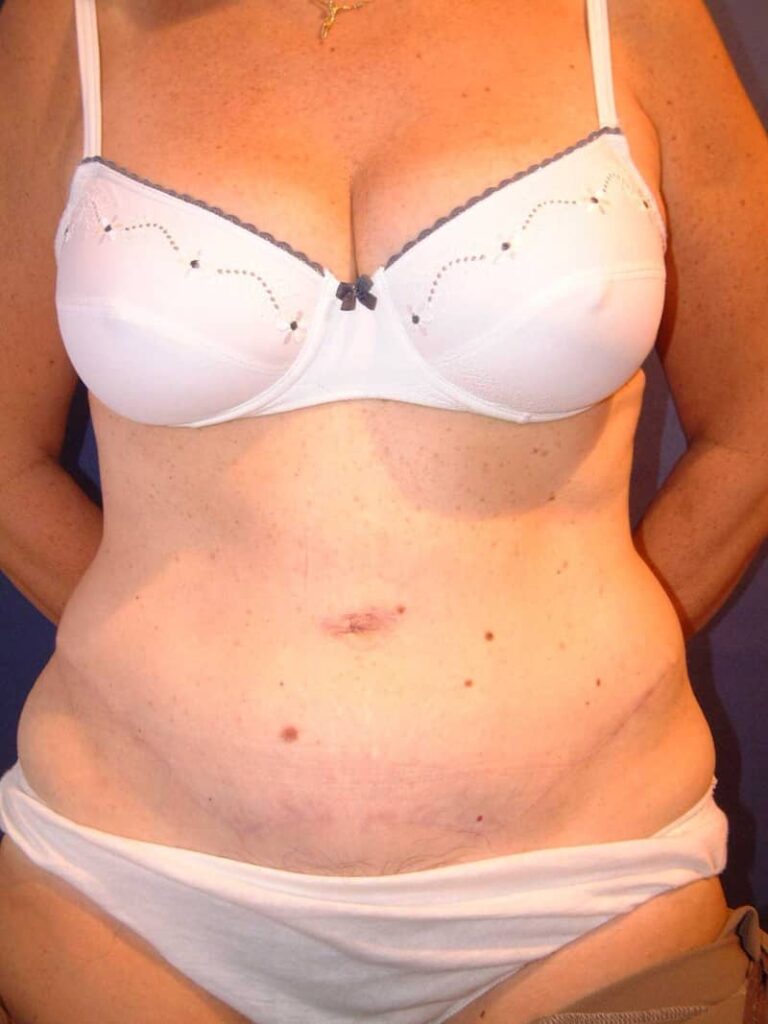 Tummy tuck after