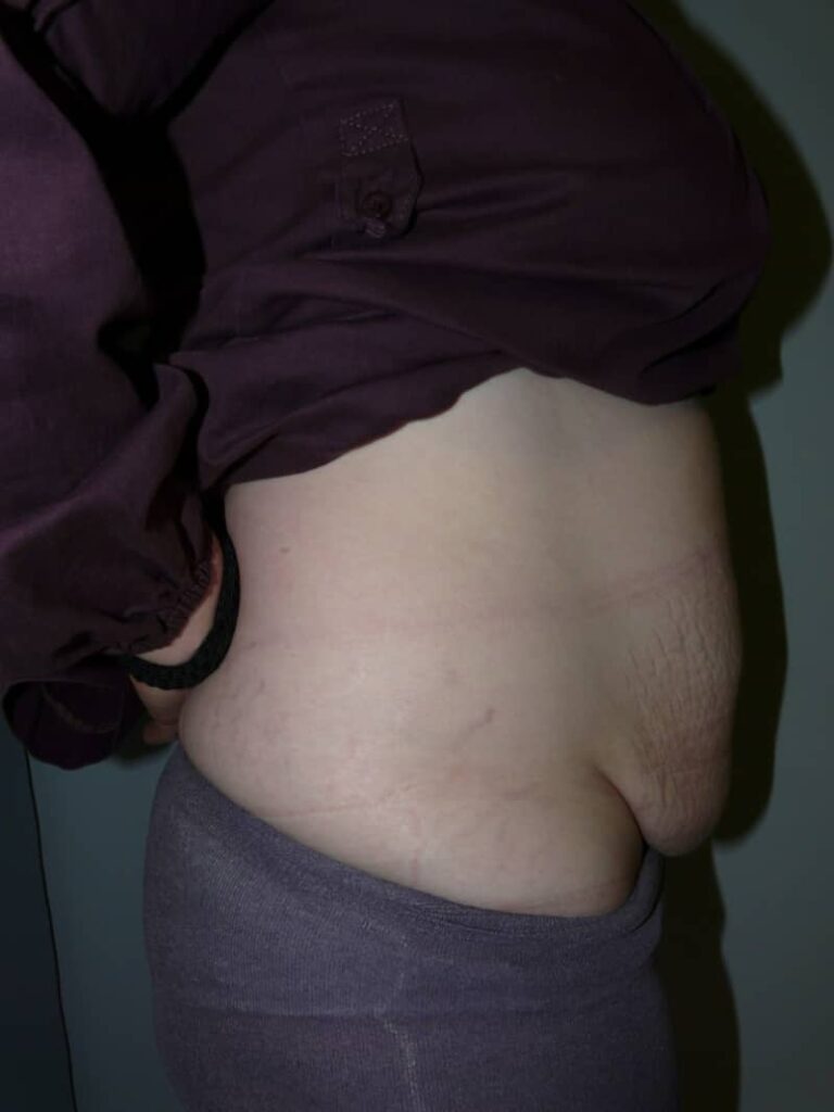 Tummy tuck case 1 before
