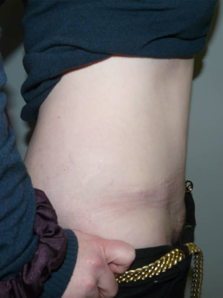 Tummy tuck case 1 after