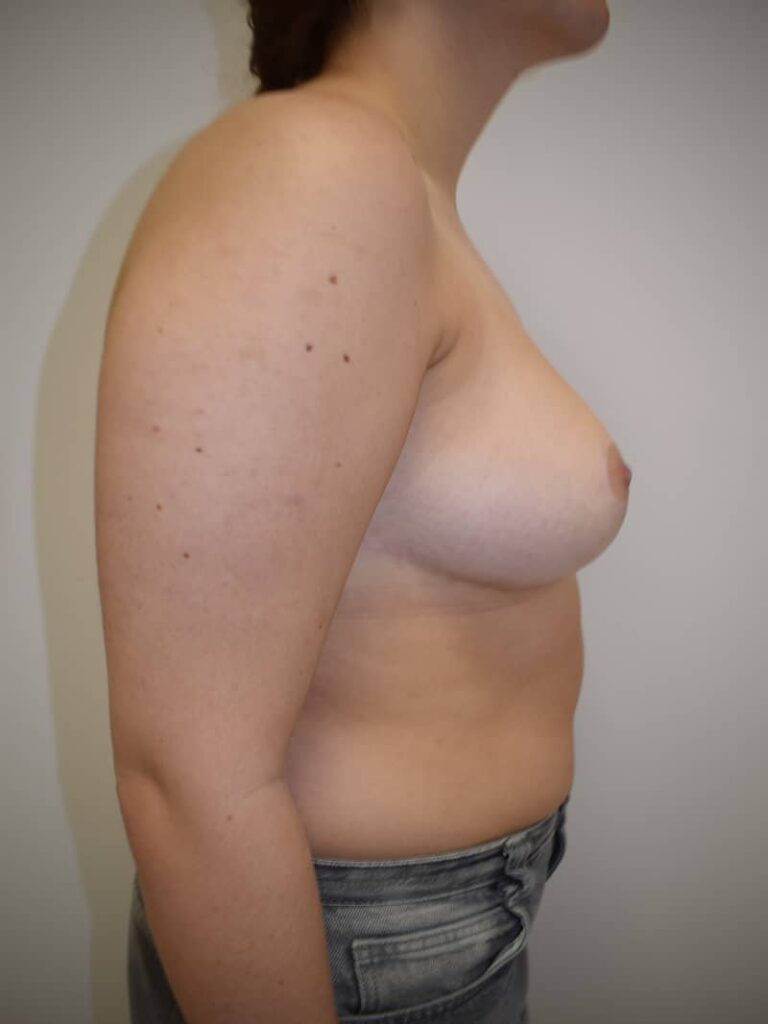 Breast reduction case 1 before