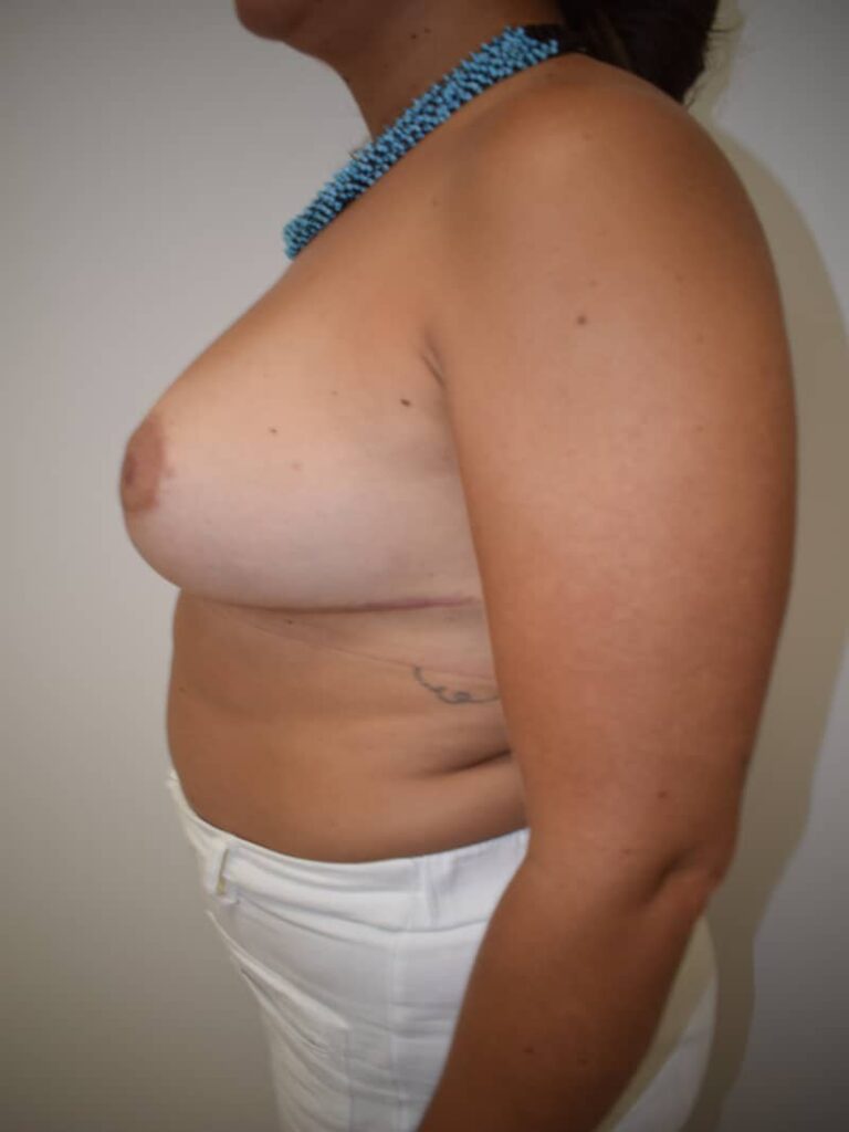 Breast reduction case 3 after