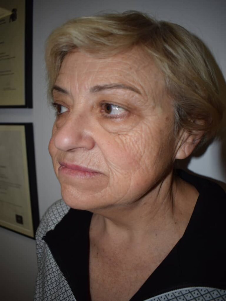 Facelift case 1 before