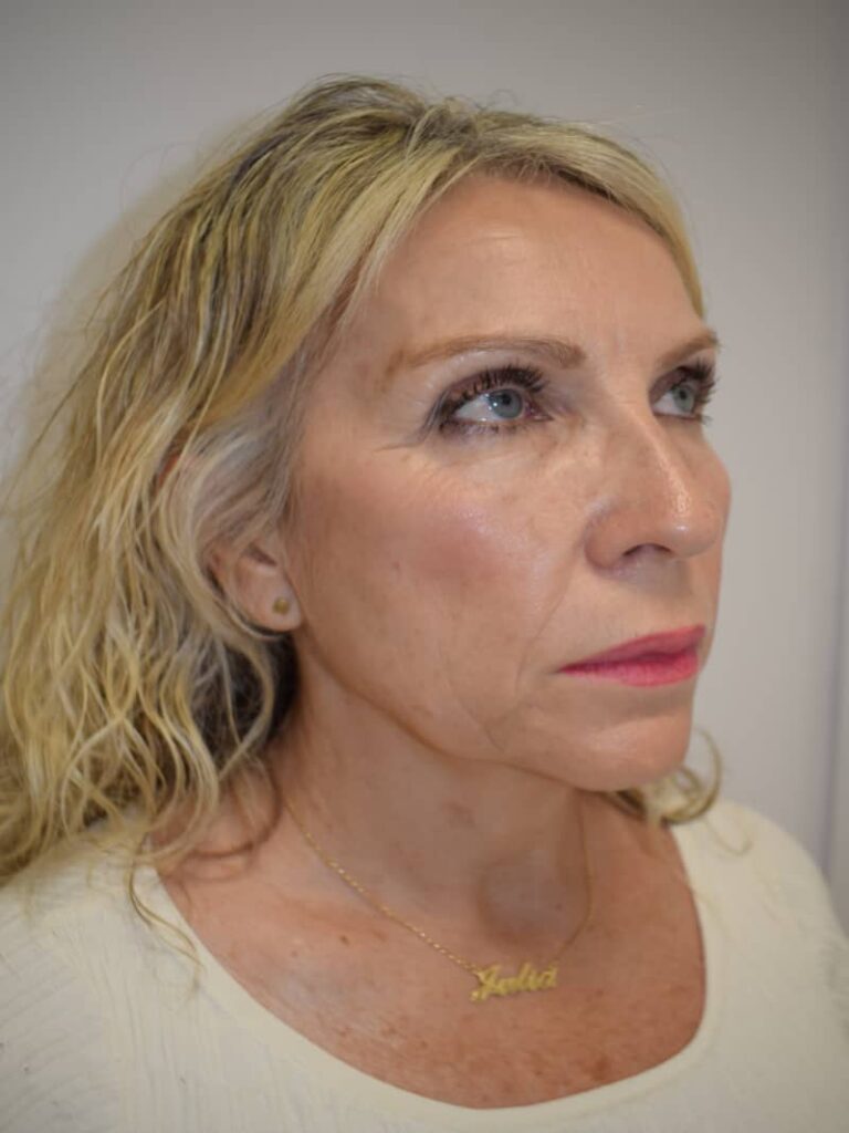 Facelift case 2 before