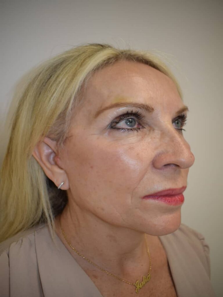 Facelift case 2 after