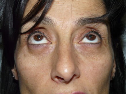 Blepharoplasty case 1 after surgery