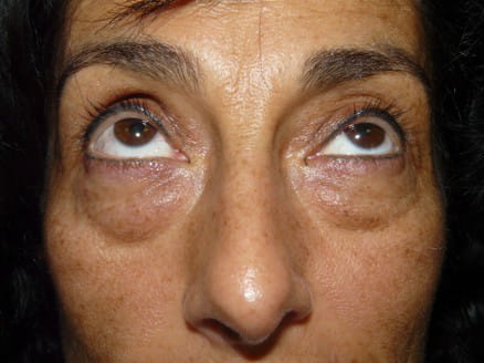 Blepharoplasty case 1 before surgery