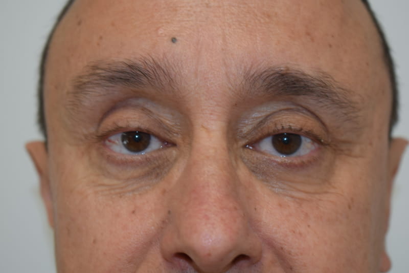 Blepharoplasty case 2 after surgery