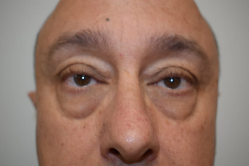 Blepharoplasty case 2 before surgery