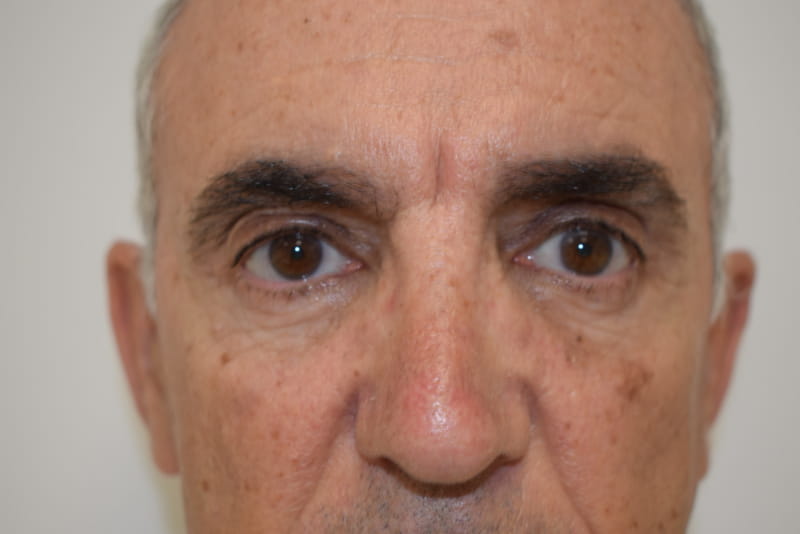 Blepharoplasty case 3 after surgery