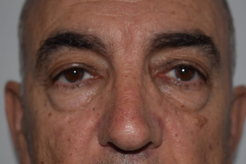 Blepharoplasty case 3 before surgery